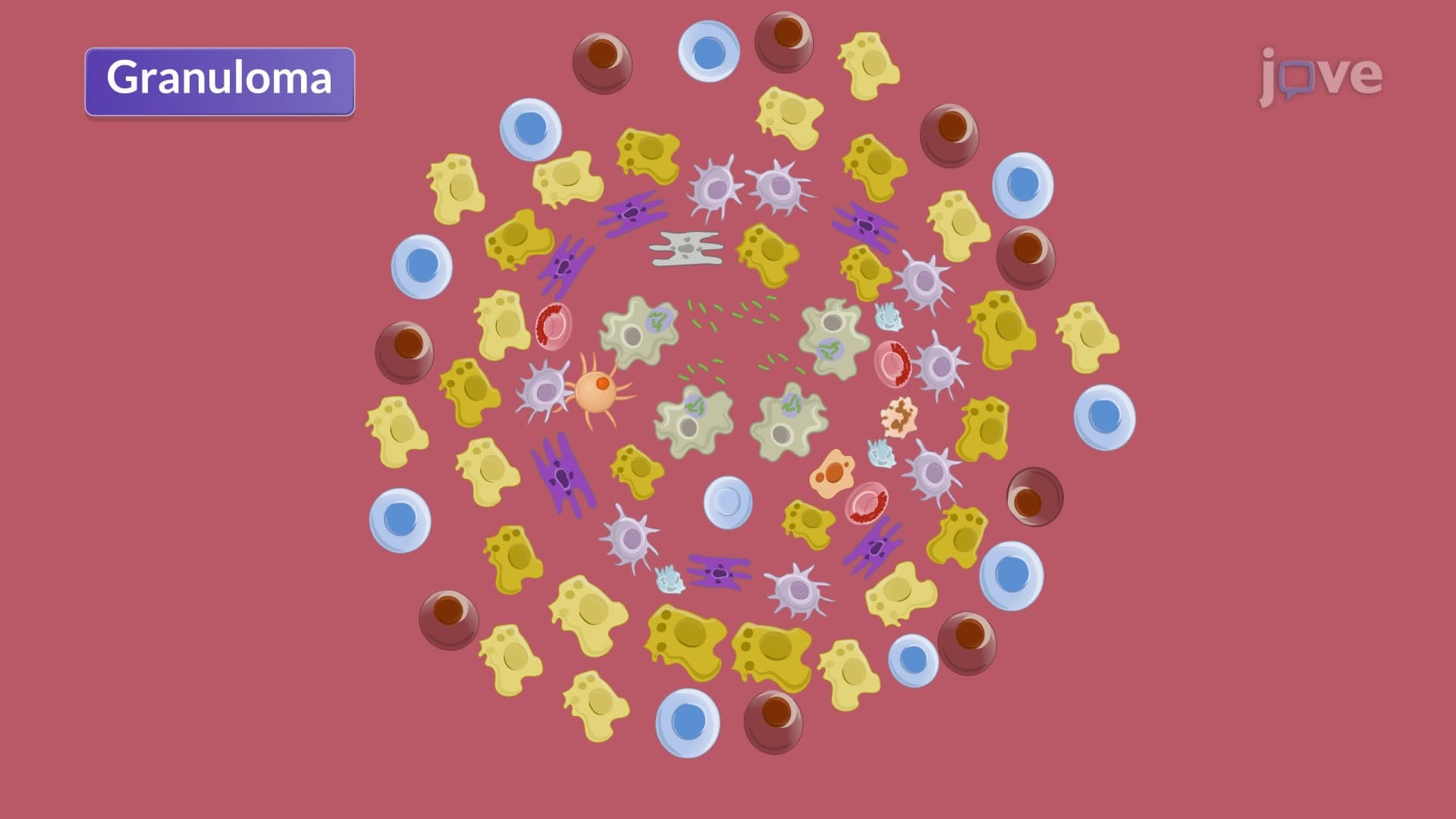 Pulmonary Tuberculosis II